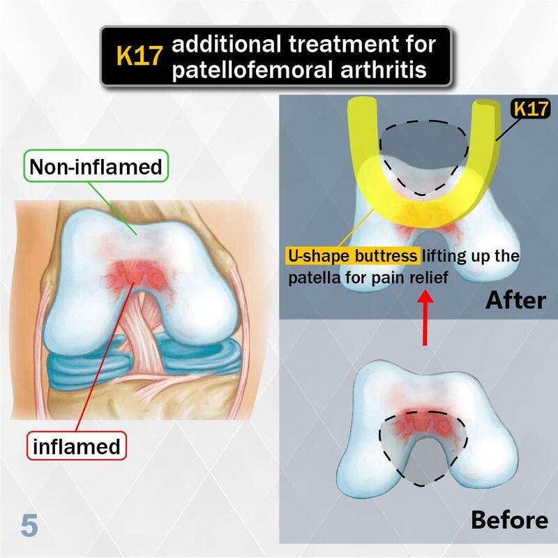 K17 - 馬蹬式髕骨矯形護托