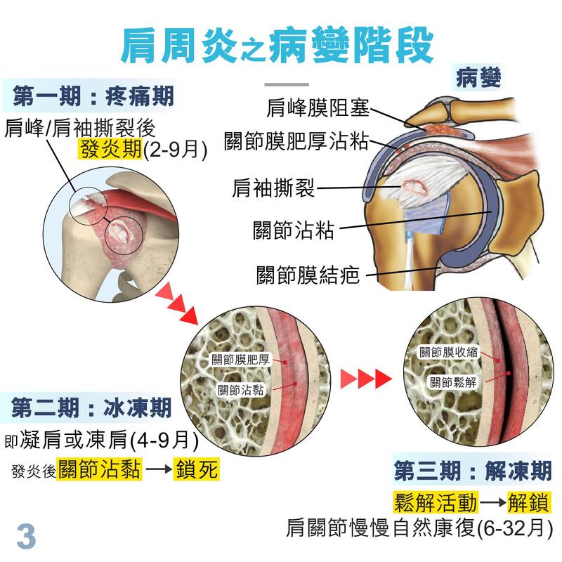 C06 左右通用肩部護托 - 黑色