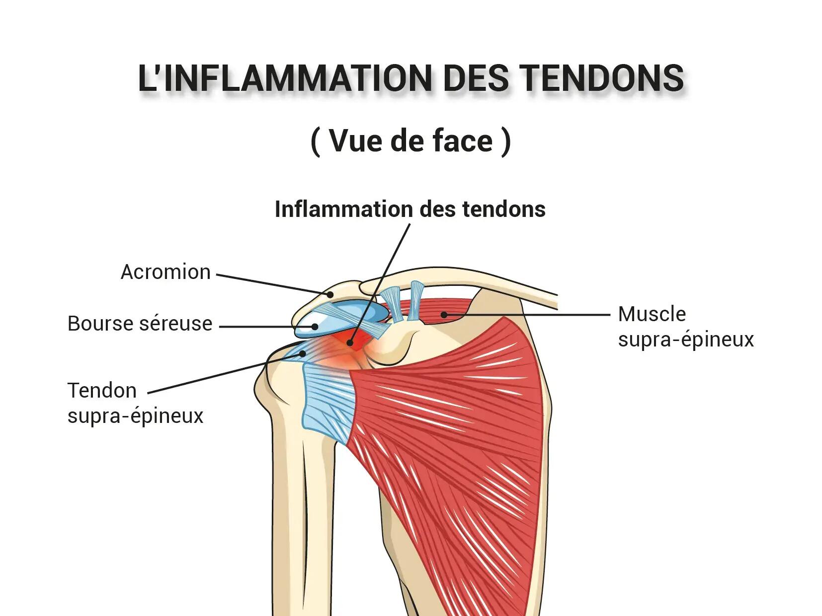 5 exercises to treat and relieve shoulder tendonitis